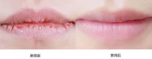 Ƽ|blistexС׹ܣרҵںףٸɵĿںҲ